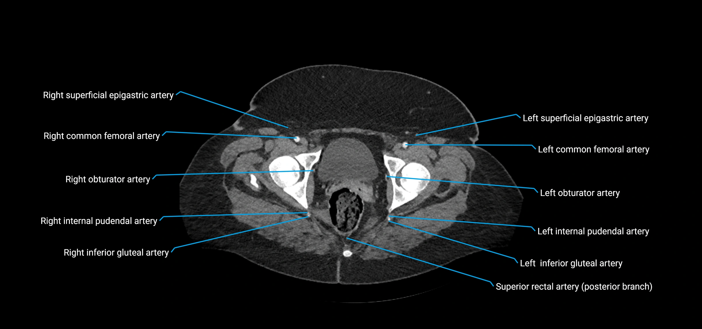 CTA abdomen axial cross sectional anatomy labelled image_246 (2).webp